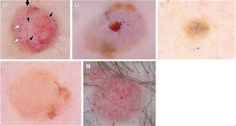 pink nodular melanoma pictures